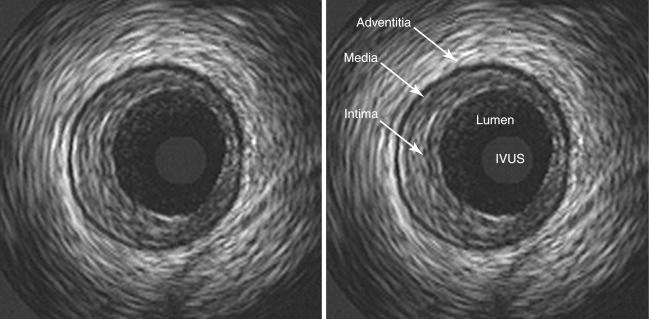 How IVUS Is Transforming Heart Diagnosis and Treatment Beyond Angiography?